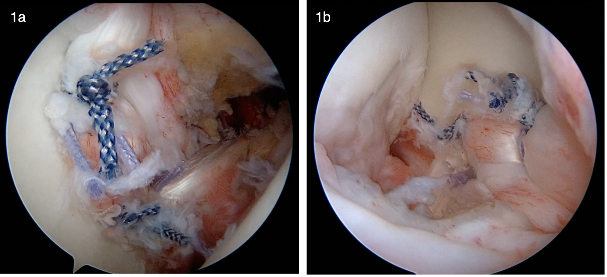 Técnica del “Hanging Biceps” (Biceps Colgante): Estabilización Anterior Dinámica Modificada con Aumento del Labrum.